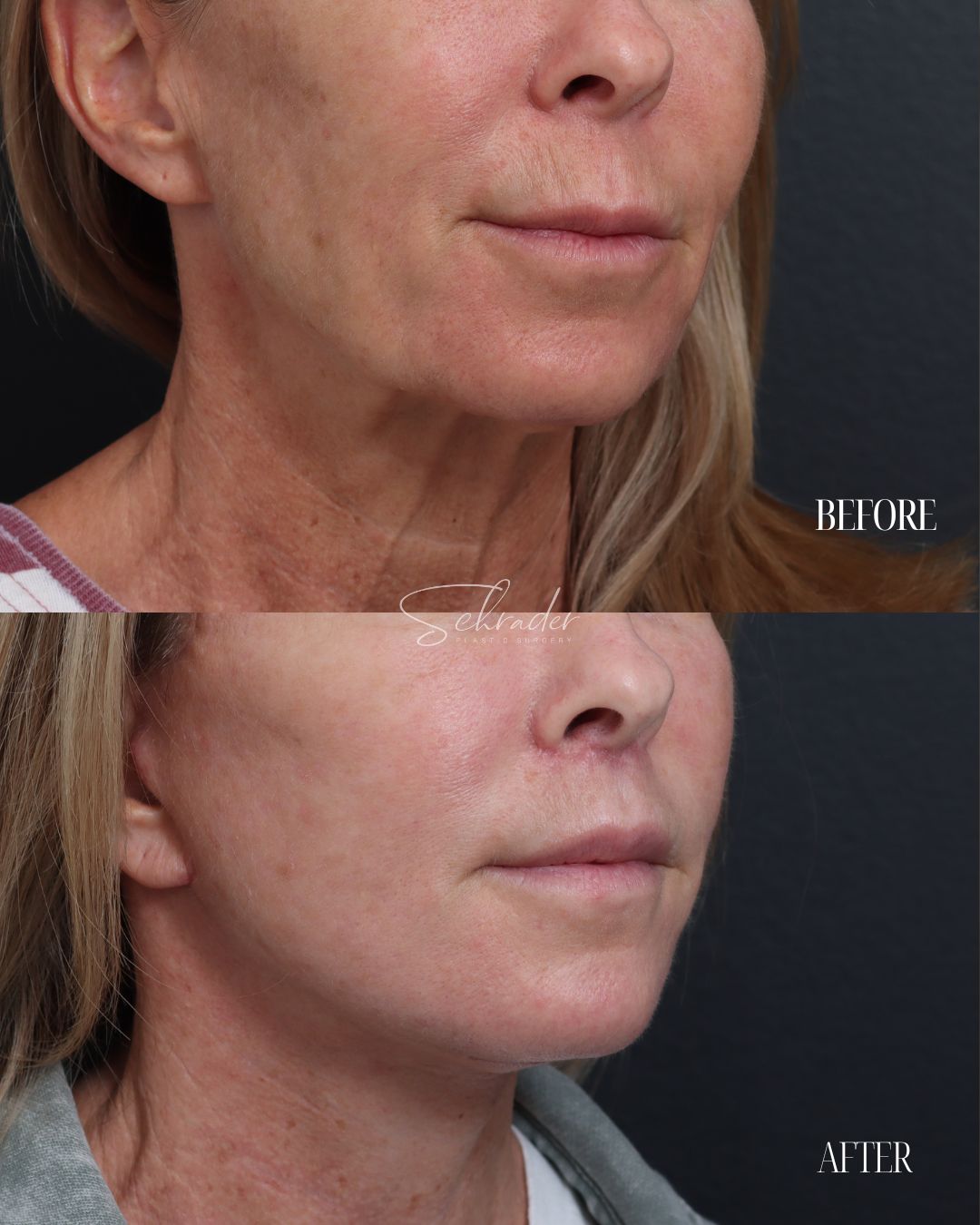 Dr Schrader Before/Afters - Jeanine Reilly (lower face) (3)