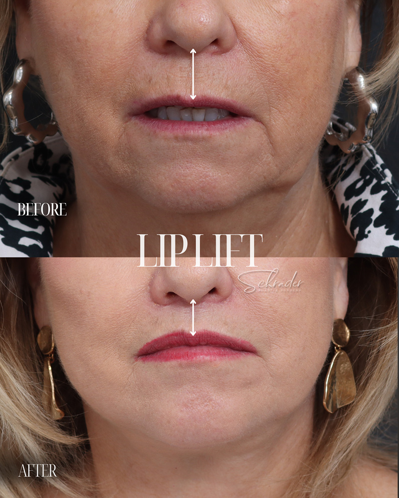 lip-lift-01-front