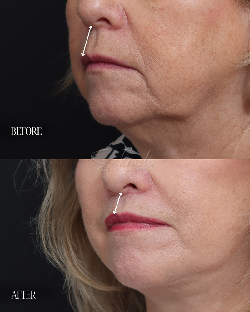 lip-lift-01-obl