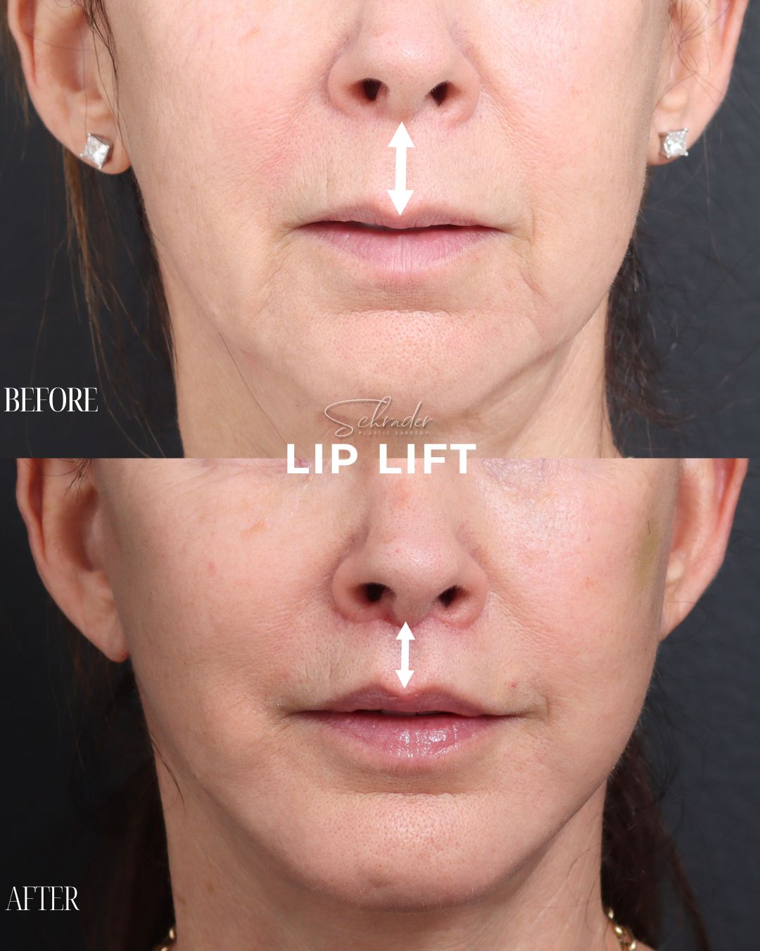 lip-lift-05-front