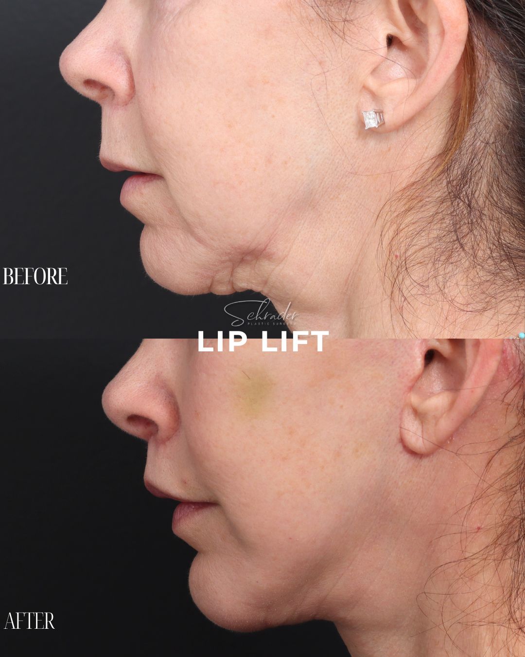 lip-lift-05-lat