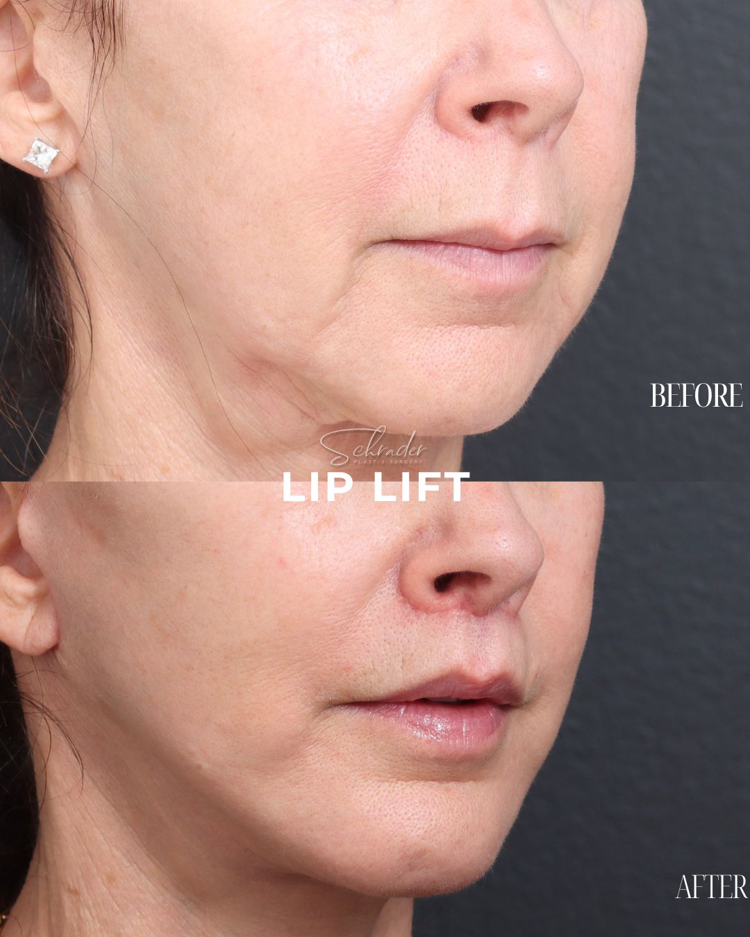 lip-lift-05-obl