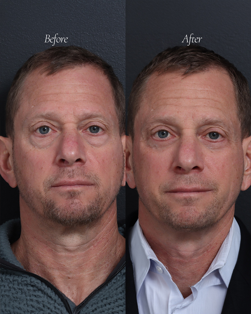 lower-blepharoplasty-40