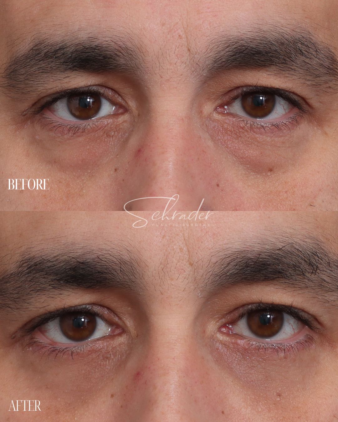 lower-blepharoplasty-fat-graft-front