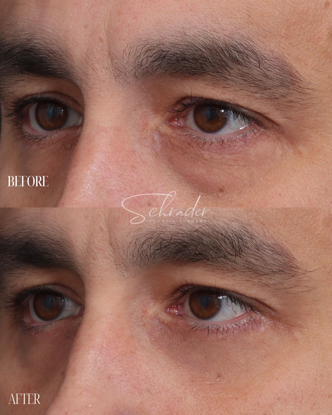 lower-blepharoplasty-fat-graft-obl