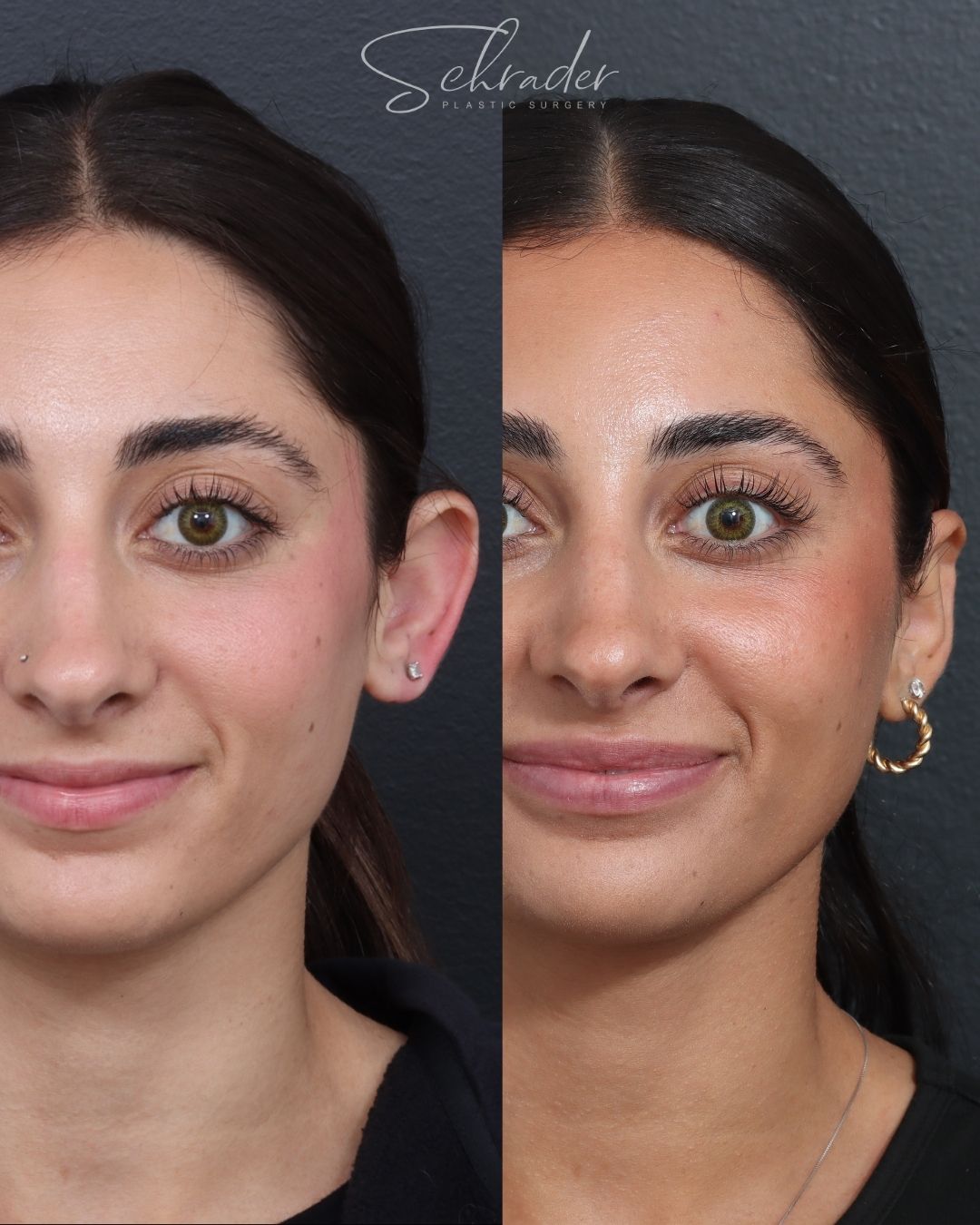 otoplasty-front