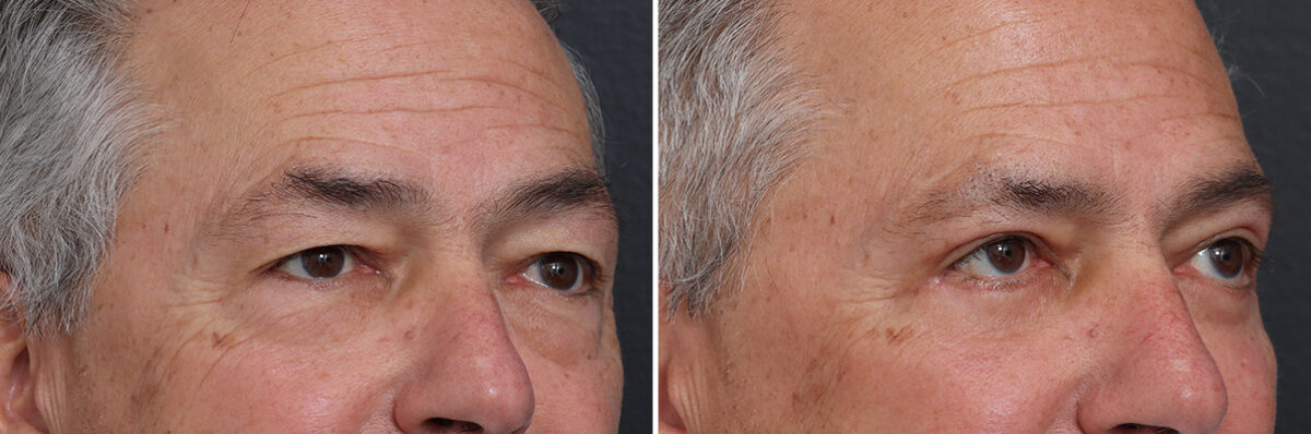 Upper and Lower Eyelid Surgery Before and After Photos in Princeton, NJ, Patient 17368