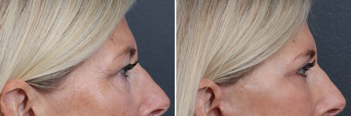 Upper and Lower Eyelid Surgery Before and After Photos in Princeton, NJ, Patient 17372
