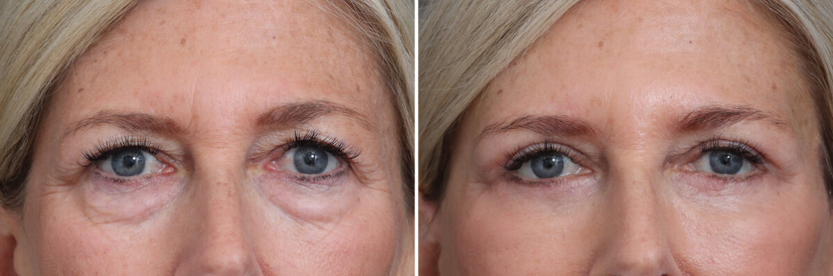 Upper and Lower Eyelid Surgery Before and After Photos in Princeton, NJ, Patient 17372