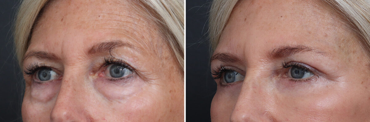Upper and Lower Eyelid Surgery Before and After Photos in Princeton, NJ, Patient 17372