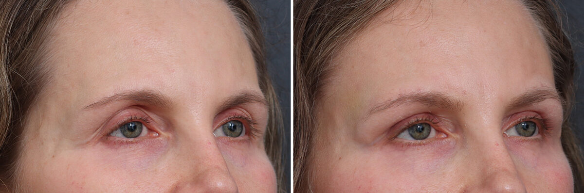 Upper Eyelid Surgery Before and After Photos in Princeton, NJ, Patient 17390