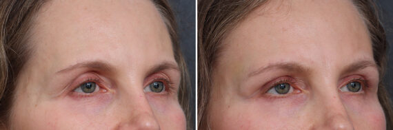 Upper Eyelid Surgery Before and After Photos in Princeton, NJ