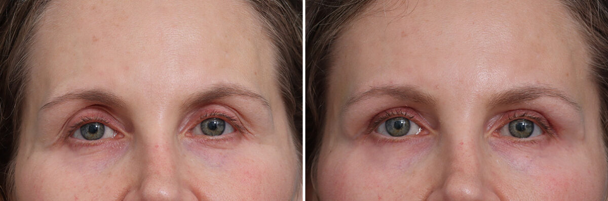 Upper Eyelid Surgery Before and After Photos in Princeton, NJ, Patient 17390