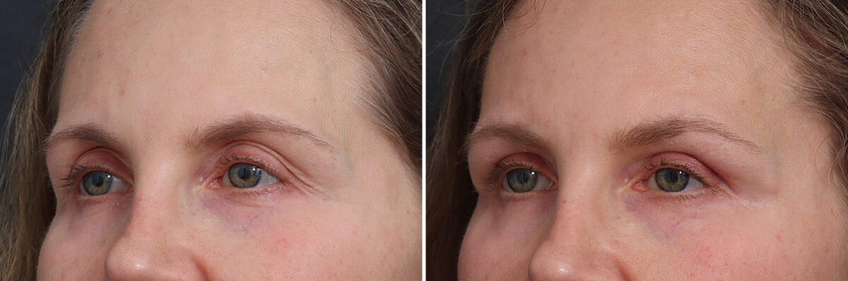 Upper Eyelid Surgery Before and After Photos in Princeton, NJ, Patient 17390