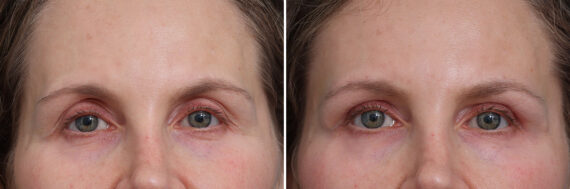 Upper Eyelid Surgery Before and After Photos in Princeton, NJ, Patient 17390