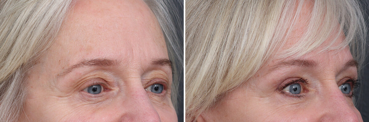 Upper Eyelid Surgery Before and After Photos in Princeton, NJ, Patient 17400
