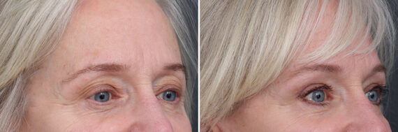 Upper Eyelid Surgery Before and After Photos in Princeton, NJ