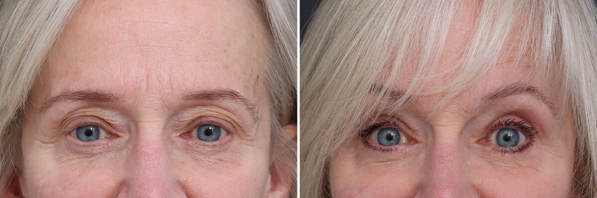 Upper Eyelid Surgery Before and After Photos in Princeton, NJ, Patient 17400