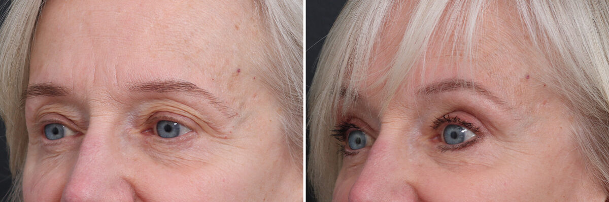 Upper Eyelid Surgery Before and After Photos in Princeton, NJ, Patient 17400