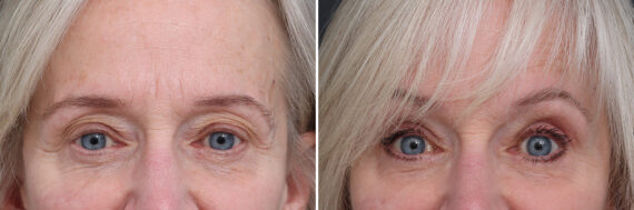 Upper Eyelid Surgery Before and After Photos in Princeton, NJ, Patient 17400