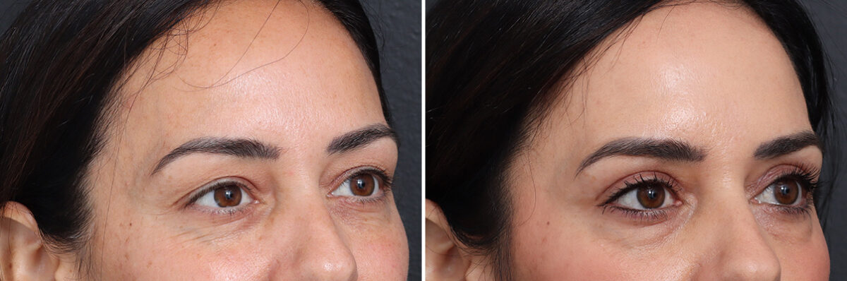 Upper Eyelid Surgery Before and After Photos in Princeton, NJ, Patient 17410