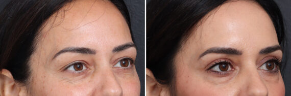 Upper Eyelid Surgery Before and After Photos in Princeton, NJ, Patient 17410