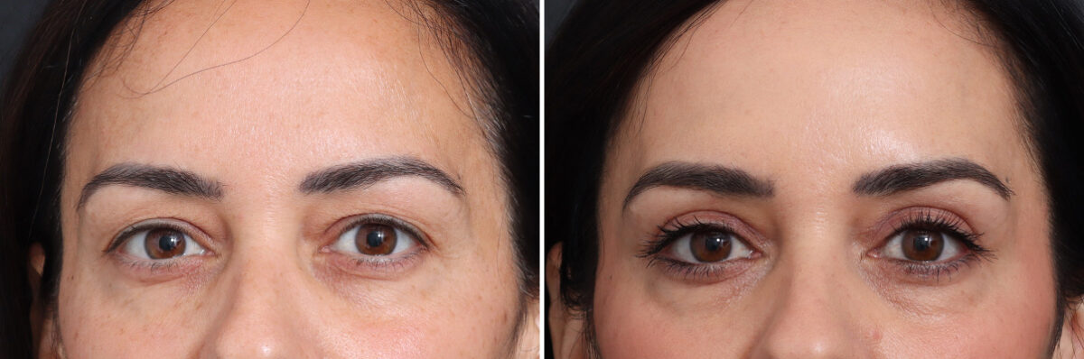 Upper Eyelid Surgery Before and After Photos in Princeton, NJ, Patient 17410