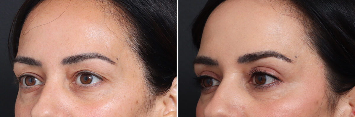 Upper Eyelid Surgery Before and After Photos in Princeton, NJ, Patient 17410