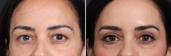 Upper Eyelid Surgery Before and After Photos in Princeton, NJ, Patient 17410