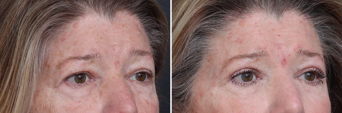 Upper Eyelid Surgery Before and After Photos in Princeton, NJ, Patient 17420