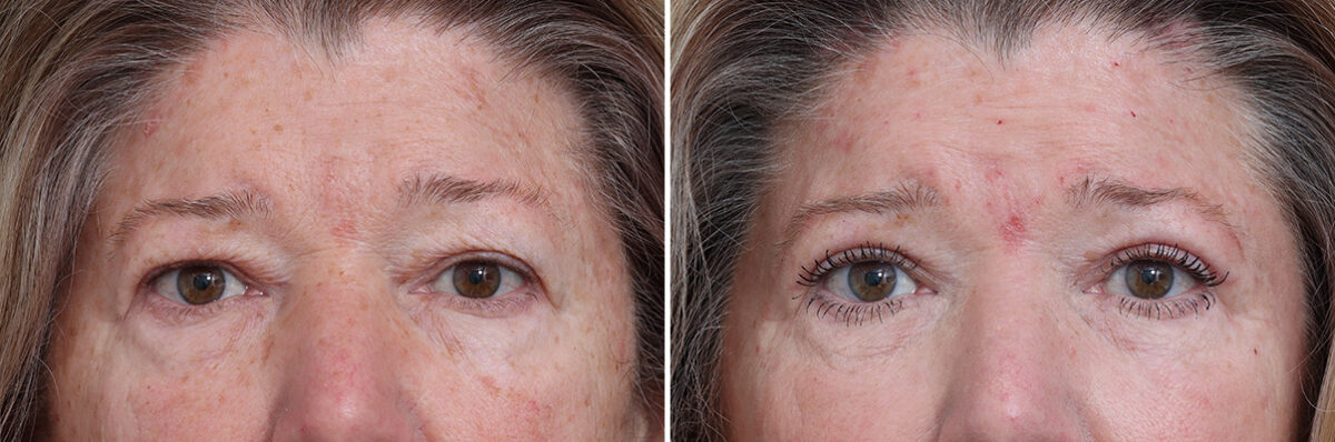 Upper Eyelid Surgery Before and After Photos in Princeton, NJ, Patient 17420