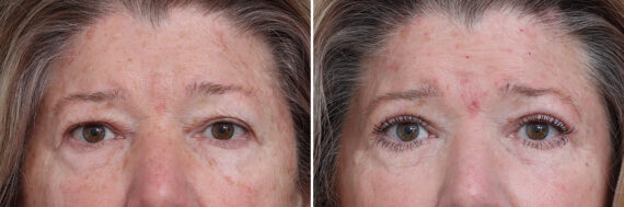 Upper Eyelid Surgery Before and After Photos in Princeton, NJ, Patient 17420