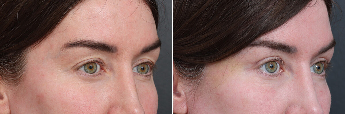 Upper Eyelid Surgery Before and After Photos in Princeton, NJ, Patient 17428