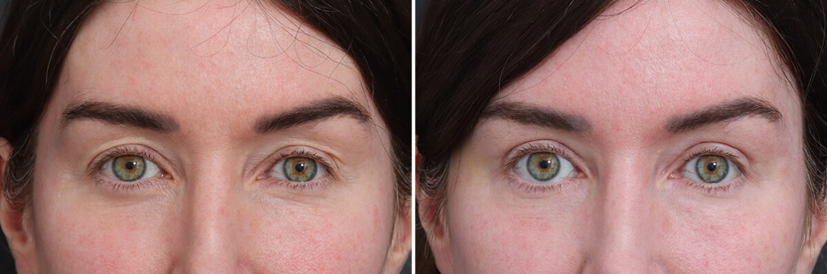 Upper Eyelid Surgery Before and After Photos in Princeton, NJ, Patient 17428