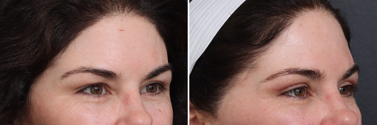 Upper Eyelid Surgery Before and After Photos in Princeton, NJ, Patient 17435