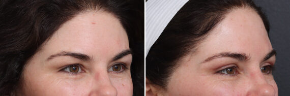 Upper Eyelid Surgery Before and After Photos in Princeton, NJ, Patient 17435