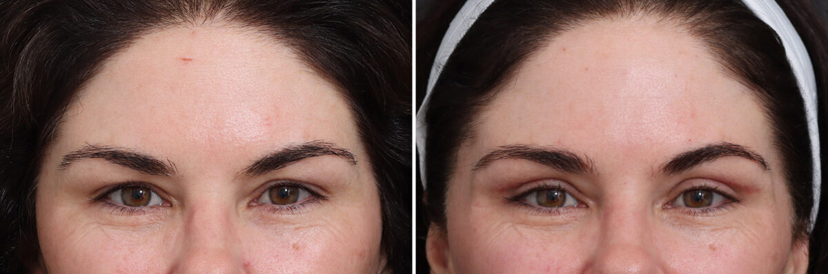 Upper Eyelid Surgery Before and After Photos in Princeton, NJ, Patient 17435