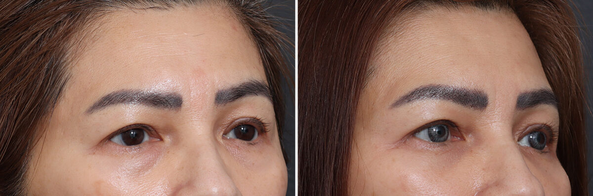 Lower Eyelid Surgery Before and After Photos in Princeton, NJ, Patient 17442
