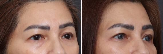 Lower Eyelid Surgery Before and After Photos in Princeton, NJ, Patient 17442