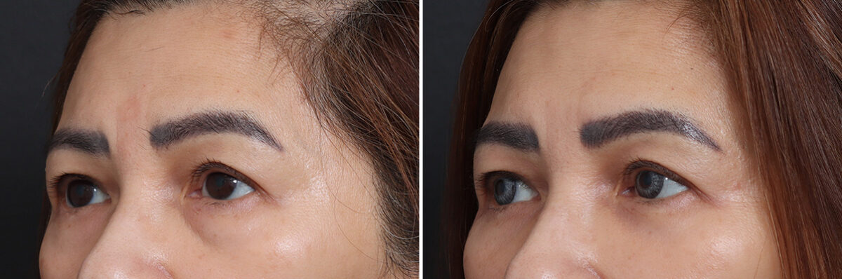 Lower Eyelid Surgery Before and After Photos in Princeton, NJ, Patient 17442