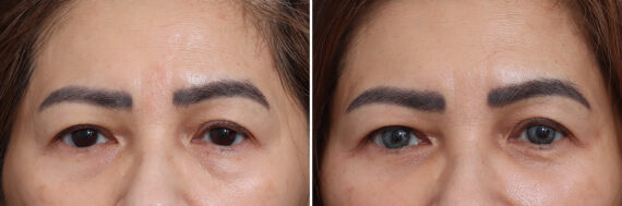 Lower Eyelid Surgery Before and After Photos in Princeton, NJ