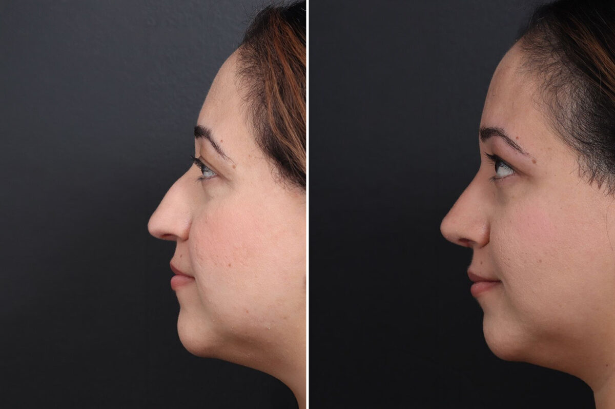 Rhinoplasty Before and After Photos in Princeton, NJ, Patient 18985