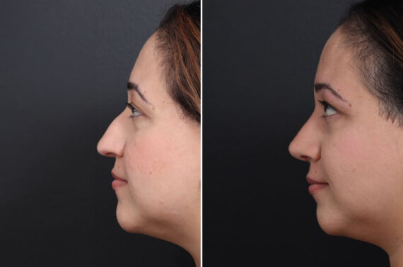 Rhinoplasty Before and After Photos in Princeton, NJ, Patient 18985