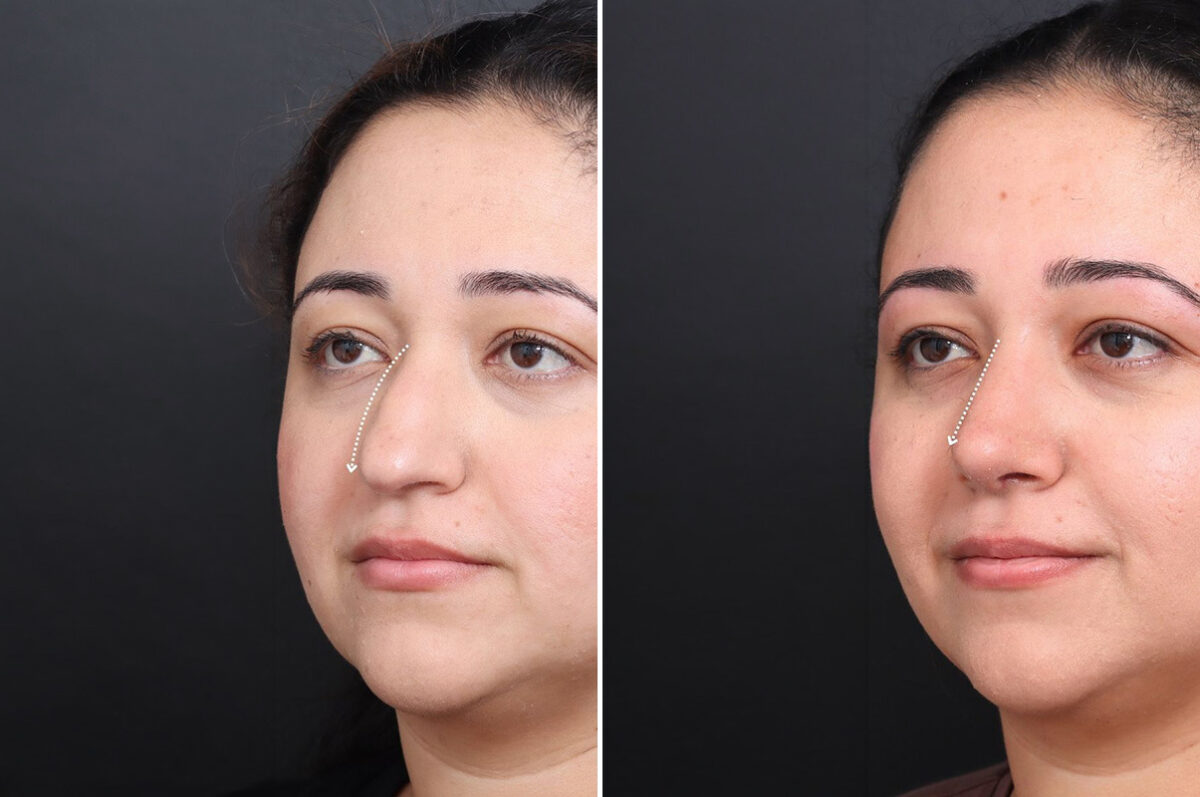 Rhinoplasty Before and After Photos in Princeton, NJ, Patient 18985
