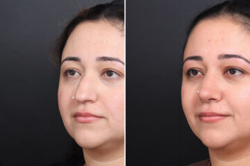 Rhinoplasty Before and After Photos in Princeton, NJ, Patient 18985