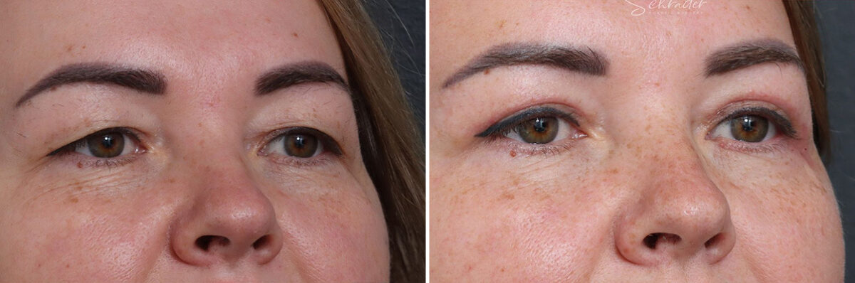 Upper Eyelid Surgery Before and After Photos in Princeton, NJ, Patient 19002