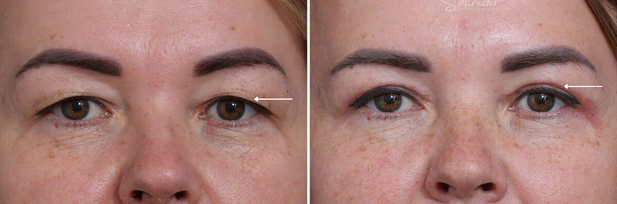 Upper Eyelid Surgery Before and After Photos in Princeton, NJ, Patient 19002