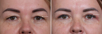 Upper Eyelid Surgery Before and After Photos in Princeton, NJ, Patient 19002