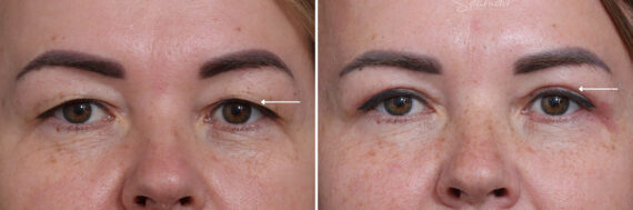 Upper Eyelid Surgery Before and After Photos in Princeton, NJ, Patient 19002