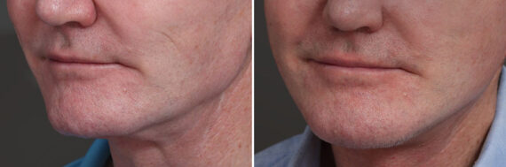 Chin Implants Before and After Photos in Princeton, NJ, Patient 19005